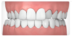 Crossbite