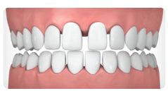 Gapped teeth