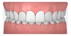 Overbite