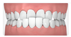 Underbite