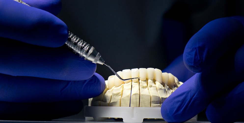 Crowns, Veneers & Bridgework at Mark Osmond Dental Clinic