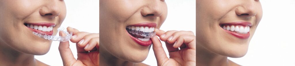 Invisalign — How It Works at Mark Osmond Dental Clinic